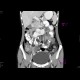 Ren arcuatus: CT - Computed tomography