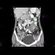 Ren arcuatus: CT - Computed tomography