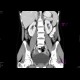 Ren arcuatus: CT - Computed tomography