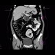 Ren migrans, moving kidney, ectopic kidney: CT - Computed tomography