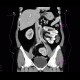 Ren migrans, moving kidney, ectopic kidney: CT - Computed tomography