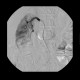 Renal cell carcinoma, RFA, embolization, follow-up: AG - Angiography