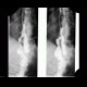 Gastrectomy, end-to-side anastomosis: RF - Fluoroscopy