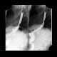 Gastrectomy, end-to-side anastomosis: RF - Fluoroscopy