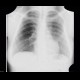 Rib anomally: X-ray - Plain radiograph
