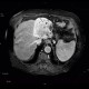 Cholangiocellular carcinoma of liver, dilation of intrahepatic ducts: MRI - Magnetic Resonance Imaging