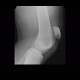 Rupture of patellar ligament: X-ray - Plain radiograph