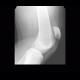 Rupture of patellar ligament: X-ray - Plain radiograph