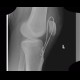 Rupture of patellar ligament, cerclage: X-ray - Plain radiograph