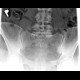 Sacroileitis on plain radiograph: X-ray - Plain radiograph