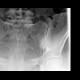 Sacroileitis on plain radiograph: X-ray - Plain radiograph