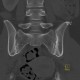 Sacroileitis: CT - Computed tomography