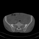 Sacroileitis in Crohn's disease: CT - Computed tomography