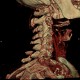 Separation of spinous process of C6 and C7, congenital: CT - Computed tomography