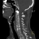 Separation of spinous process of C6 and C7, congenital: CT - Computed tomography