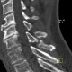 Separation of spinous process of C6 and C7, congenital: CT - Computed tomography