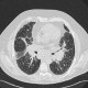 Sarcoidosis of lung, HRCT, hilar lymphadenopathy: CT - Computed tomography
