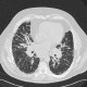 Sarcoidosis of lung, HRCT, hilar lymphadenopathy: CT - Computed tomography