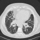Sarcoidosis of lung, HRCT, hilar lymphadenopathy: CT - Computed tomography