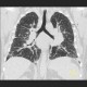 Sarcoidosis of lung, HRCT, hilar lymphadenopathy: CT - Computed tomography