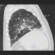 Sarcoidosis of lung, HRCT, hilar lymphadenopathy: CT - Computed tomography