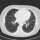 Lung sarcoidosis: CT - Computed tomography