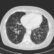 Lung sarcoidosis: CT - Computed tomography