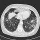 Lung sarcoidosis: CT - Computed tomography