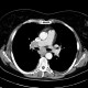 Lung sarcoidosis: CT - Computed tomography