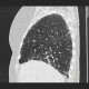 Lung sarcoidosis: CT - Computed tomography
