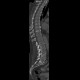 Schmorl's nodes: CT - Computed tomography