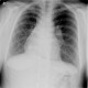 Scimitar syndrom, anomalous return of pulmonary vein: X-ray - Plain radiograph