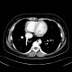 Scimitar syndrom, anomalous return of pulmonary vein: CT - Computed tomography