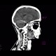 Subdural hematoma on tentorium: CT - Computed tomography