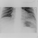 Bowel obstruction, carcinoma of sigmoid colon, SBO, ileus, colorectal cancer: X-ray - Plain radiograph