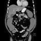 Bowel obstruction, carcinoma of sigmoid colon, SBO, ileus, colorectal cancer: CT - Computed tomography