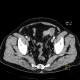 Bowel obstruction, carcinoma of sigmoid colon, SBO, ileus, colorectal cancer: CT - Computed tomography