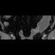 Bowel obstruction, carcinoma of sigmoid colon, SBO, ileus, colorectal cancer: CT - Computed tomography