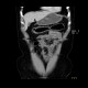 Singultus, hiccups, artifact: CT - Computed tomography