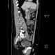 Singultus, hiccups, artifact: CT - Computed tomography