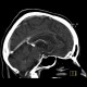 Pacchioni's granulation in sinus rectus: CT - Computed tomography