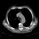 Skin folds, mimic of pneumothorax, PNO: CT - Computed tomography