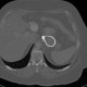 Gastric banding, slipped: CT - Computed tomography