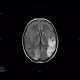 SLE, systemic lupus erythematodes, cerebral ischemia: MRI - Magnetic Resonance Imaging