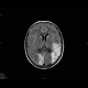 SLE, systemic lupus erythematodes, cerebral ischemia: MRI - Magnetic Resonance Imaging