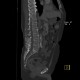 Separate apophysis of spinous process, lumbar vertebra: CT - Computed tomography