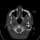 Spina bifida, atlas: CT - Computed tomography