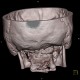 Spina bifida, atlas: CT - Computed tomography