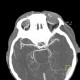Ophthalmic artery, dilated: CT - Computed tomography