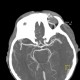 Ophthalmic artery, dilated: CT - Computed tomography